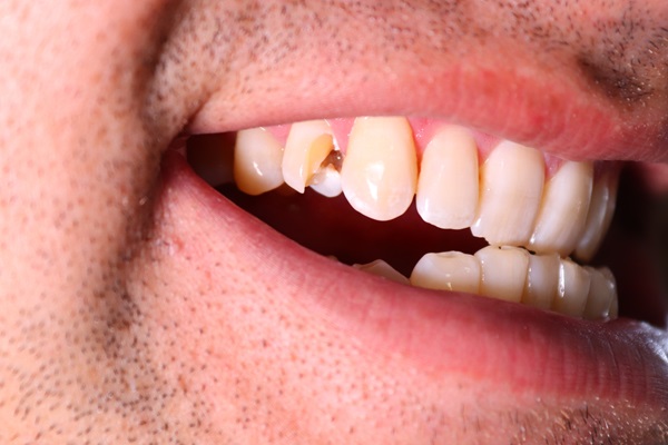 Dental Restoration Treatments For A Broken Tooth