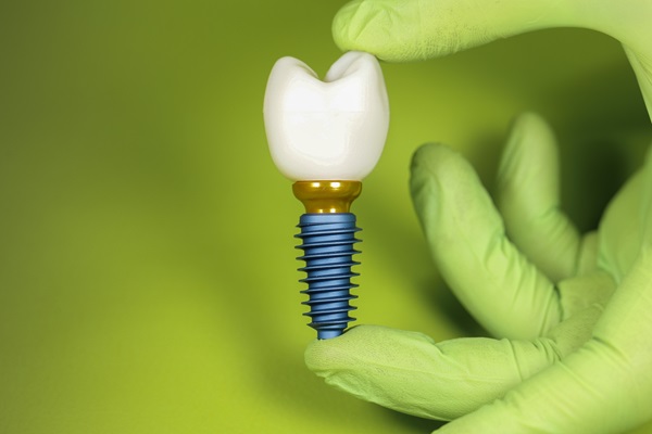 Questions To Ask A Dentist About Implant Crowns