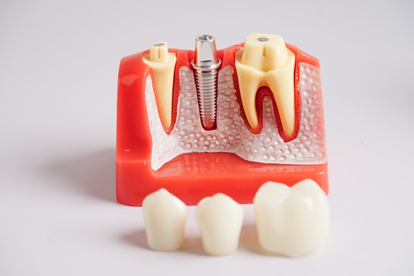 Single Tooth Replacement Options